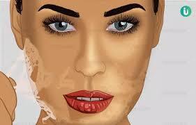 Chemisches Peeling- Chemical Peeling image