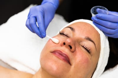 Chemisches Peeling- Chemical Peeling image