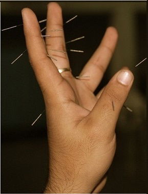 Βελονισμός