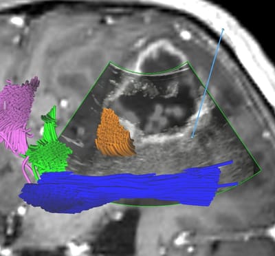 Intraoperative integrated ultrasound image