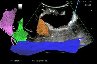 Intraoperative integrated ultrasound image