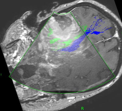Intraoperative integrated ultrasound image
