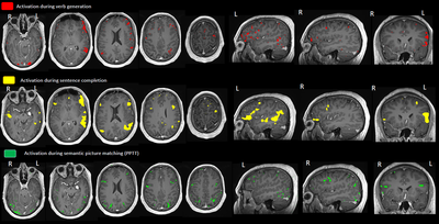 Pre-operative functional MRI image