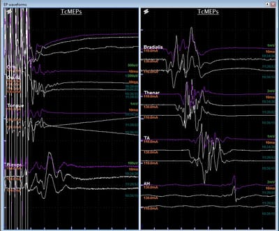 Intraoperative neurophysiology image