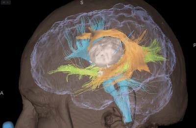 Awake craniotomy for tumour image