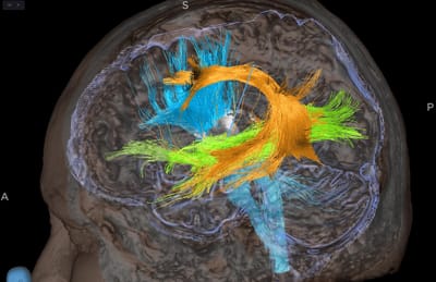 Awake craniotomy for tumour image