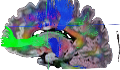 Oxford Brain Tumour Team