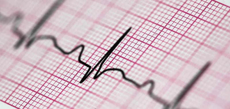 ELETROCARDIOGRAMA (ECG)