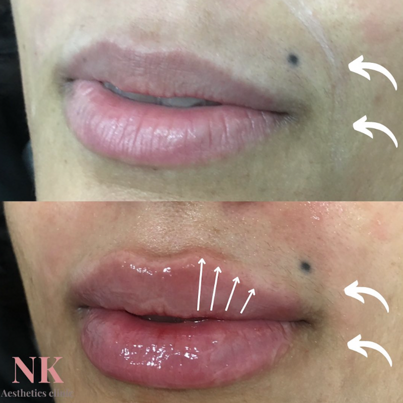 Lip filler & Mouth lines (2ml Dermal filler)