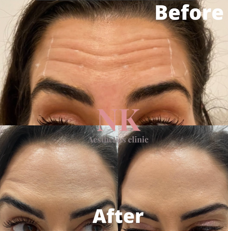 Forehead & eyebrow lift (Anti-wrinkle treatment 2 areas)