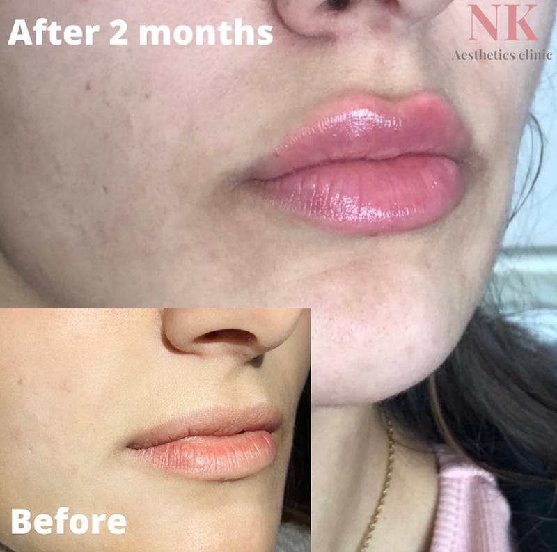 Lip filler & mouth lines (2ml Dermal filler)