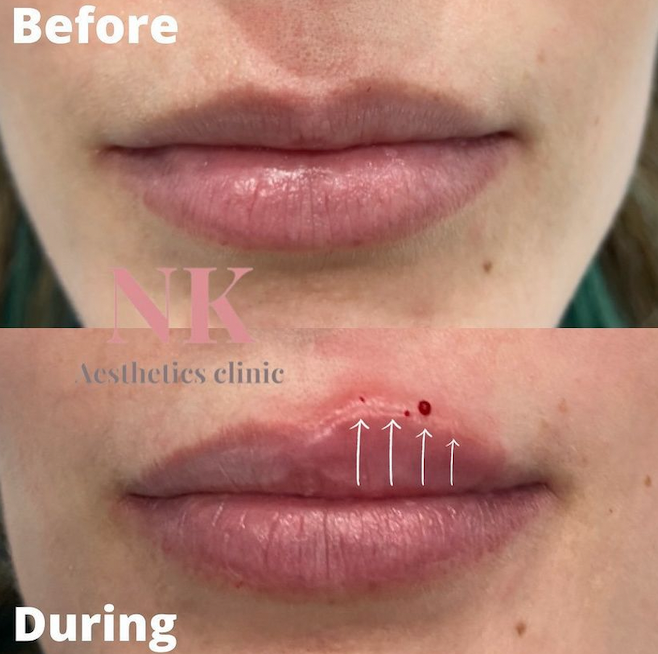 Dermal Lip filler