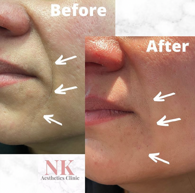 Mouth lines/Marionette lines treatment using dermal filler (1ml)