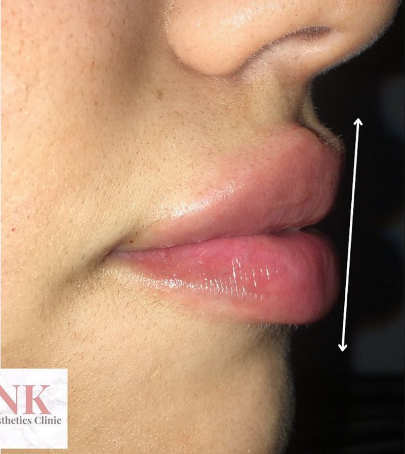 Russian lip technique Dermal lip filler