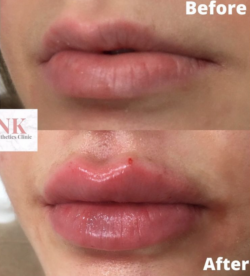 Lip asymmetry correction