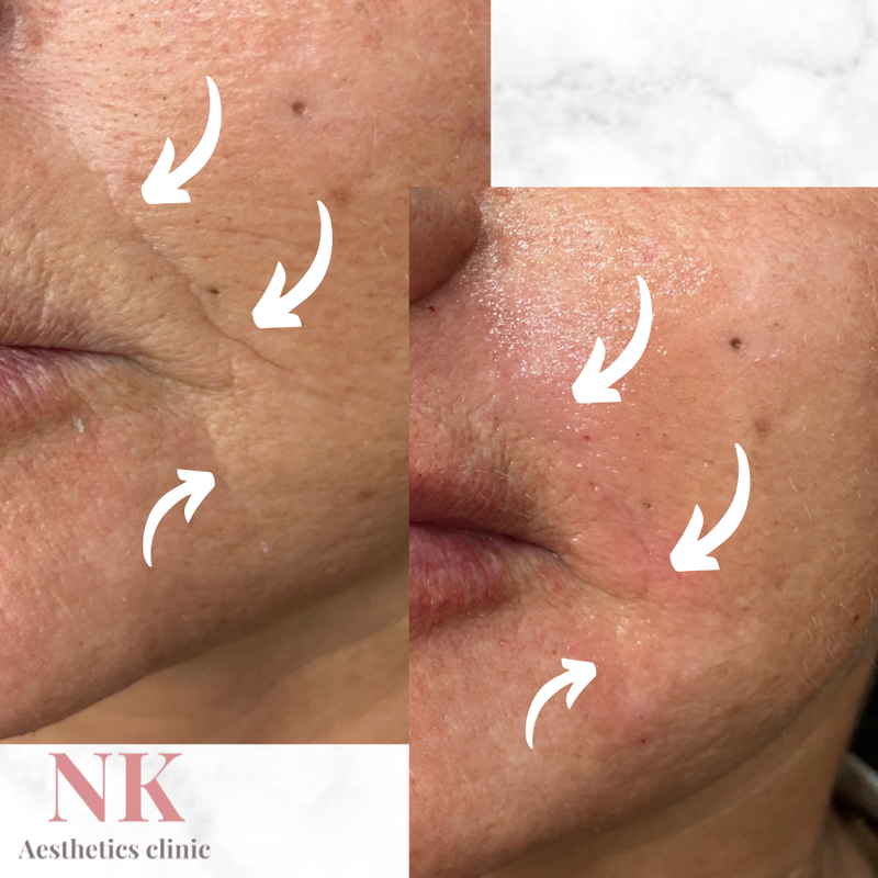 Treatment of the Nasolabial & Marionette lines using Dermal filler