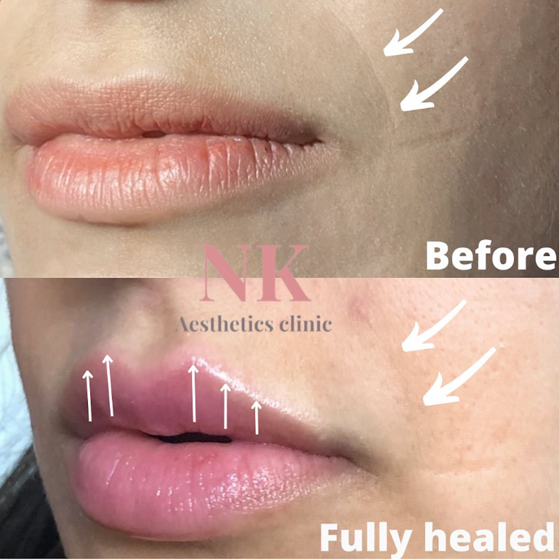 Lip filler & mouth lines