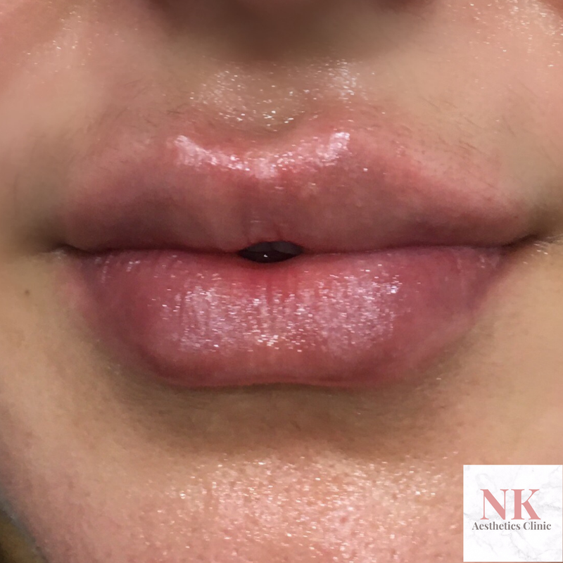 Lip filler "Russian Lip" technique