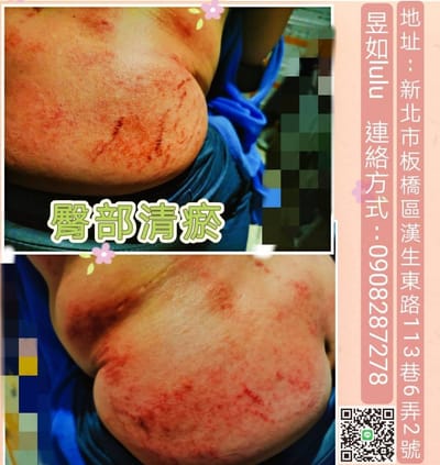 臀部 是最毒最寒涼之處 所吃的垃圾都囤積之處 -專治婦科和男科& 腿部酸痛 疾病的要穴！