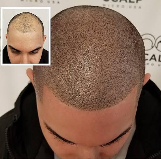 scalp micropigmentation