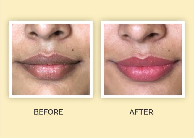 Lip Pigmentation