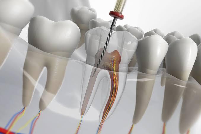 Endodoncia