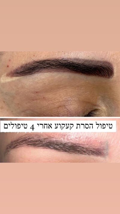 הסרת קעקוע image