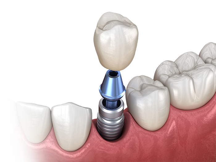 Implantologie dentară