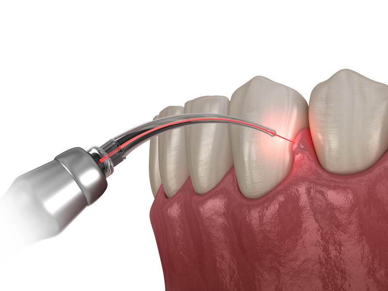 Tratamente laser