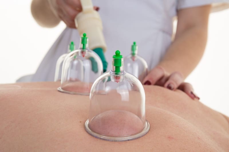 Cupping Therapy (Dry)