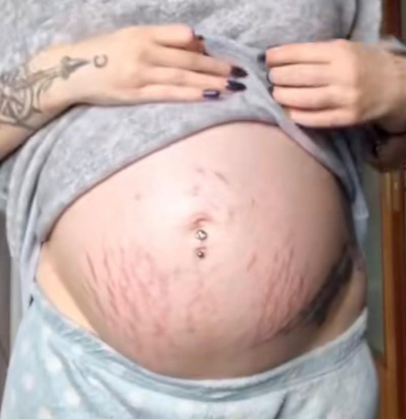 מתי מתחילים סימני מתיחה בהריון?