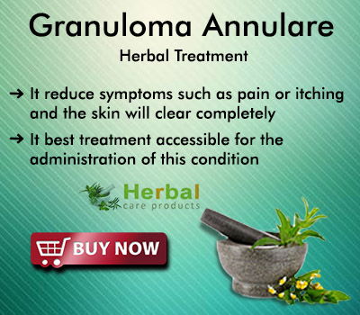 What is a Granuloma Annulare Symptoms, causes, and Natural Remedies