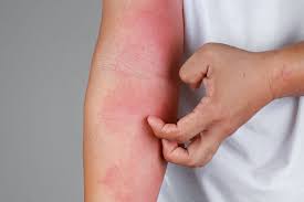 Eczema