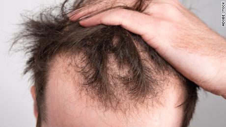 Alopecia (Hair Loss)