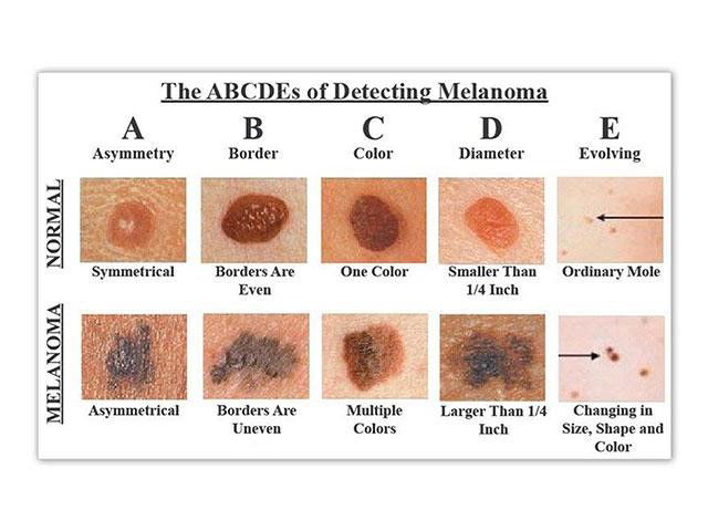 Skin Cancer