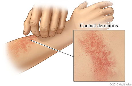 Contact Dermatitis