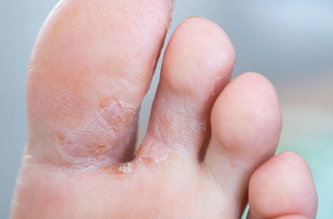 Fungal Infections