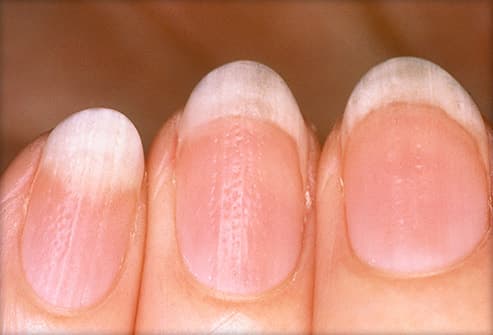 Nail Abnormalities