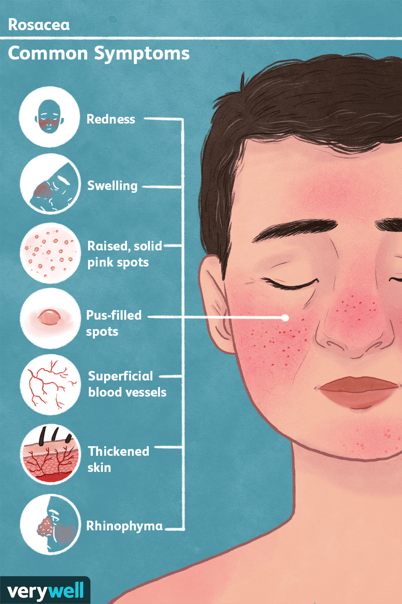 Rosacea