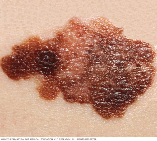 Skin Cancer Overview