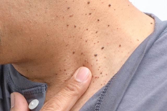 Skin Tags