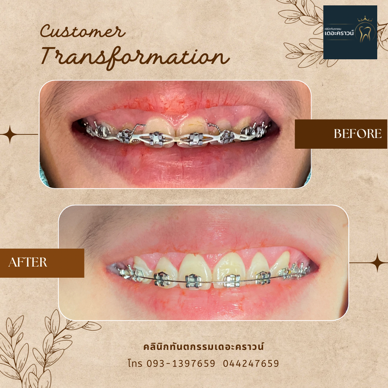 Gum laser l เลเซอร์เหงือก