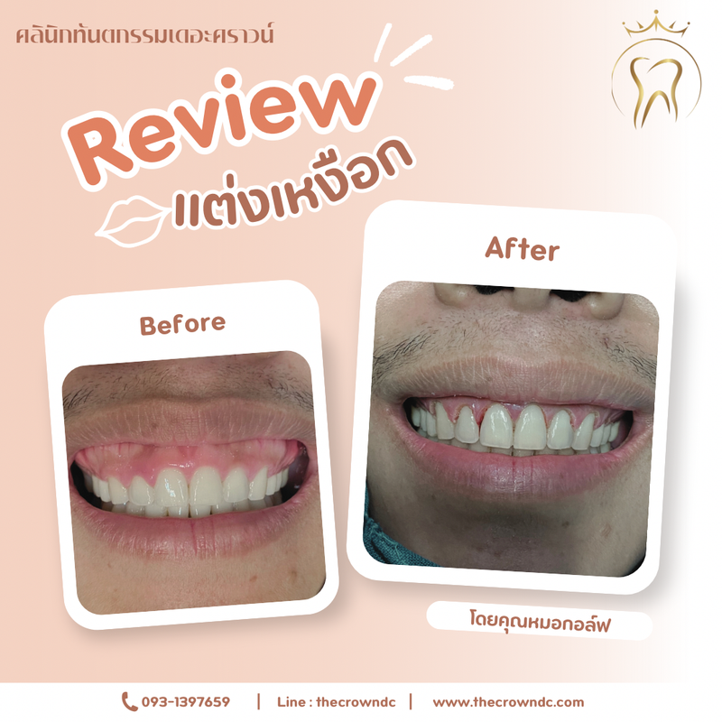 Gum laser l เลเซอร์เหงือก