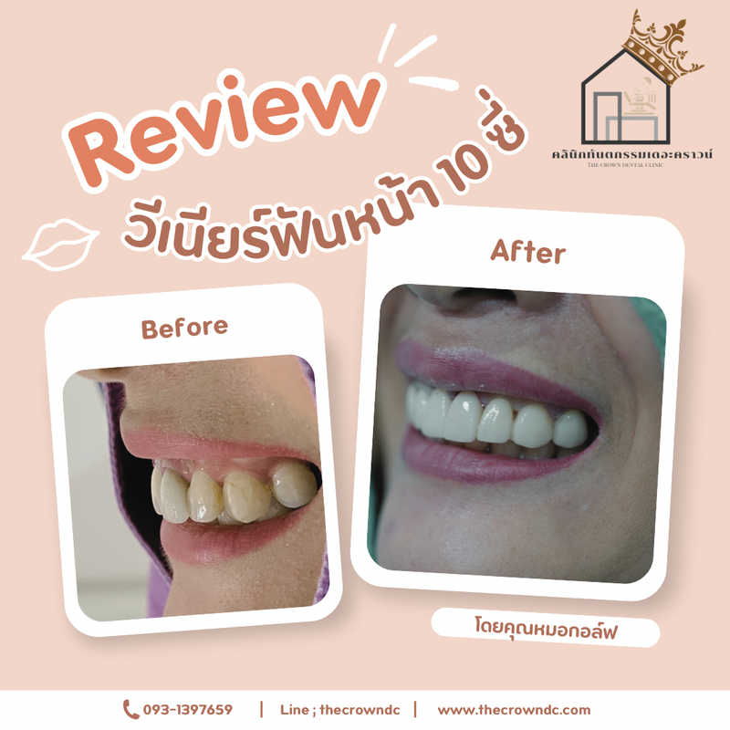 Ceramic veneers | เซรามิกวีเนียร์