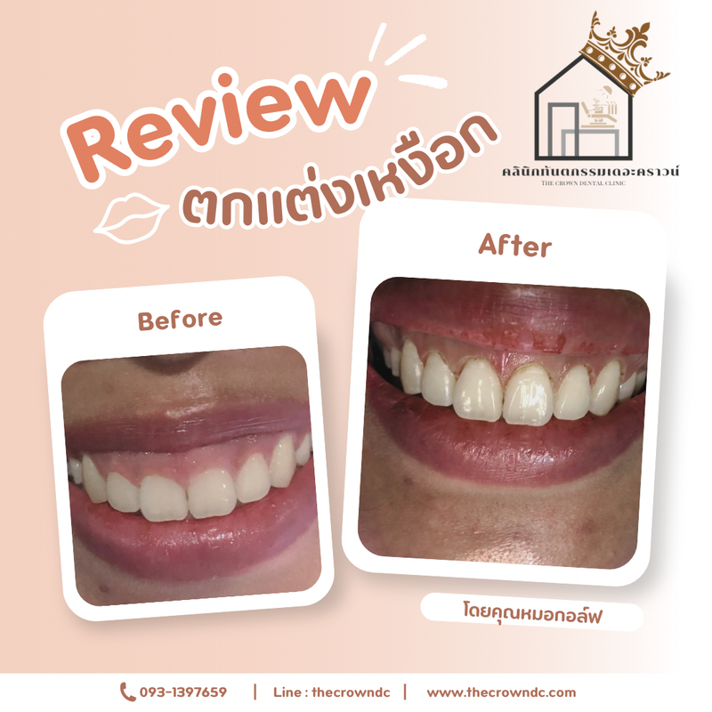 Gum laser l เลเซอร์เหงือก