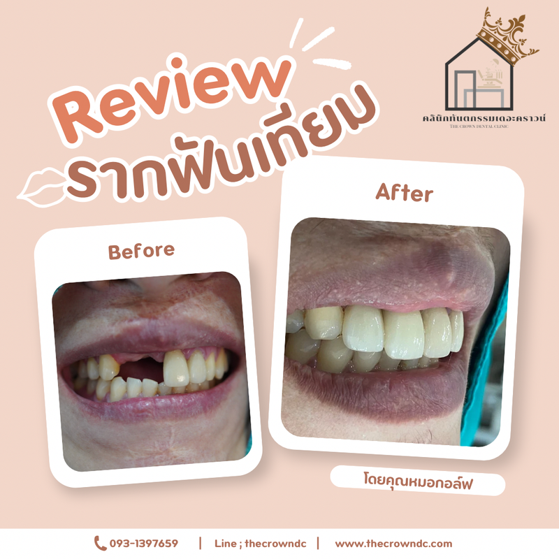 Dental implant l งานรากฟันเทียม 