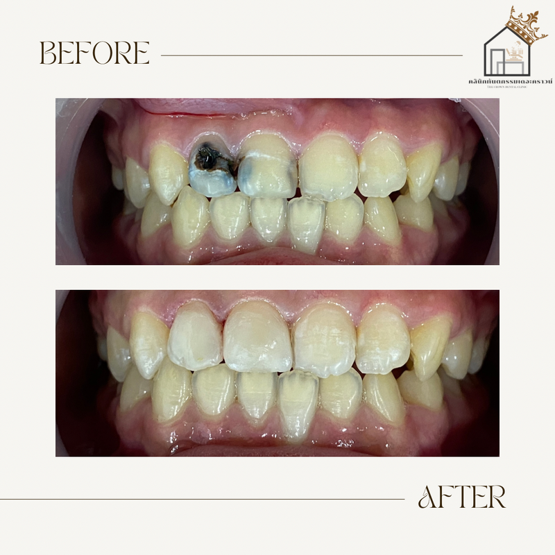 Composite filling | งานอุดฟันคอมพอสิต