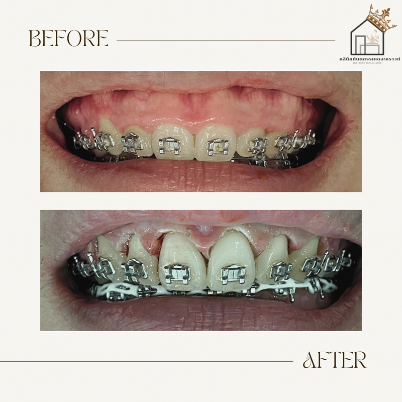 Gum laser l เลเซอร์เหงือก