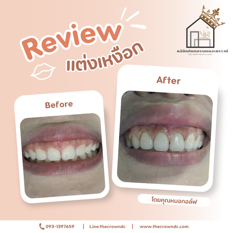 Gum laser l เลเซอร์เหงือก