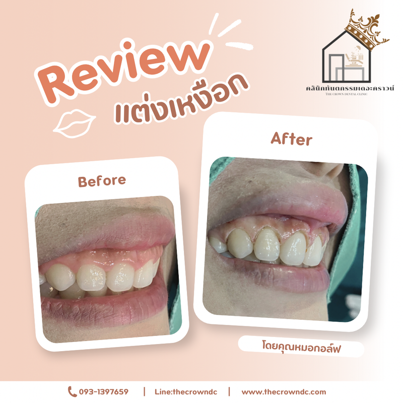 Gum laser l เลเซอร์เหงือก